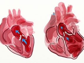 Transplantierte Herzen geben Risikogene für Herz-Kreislauf-Erkrankungen preis