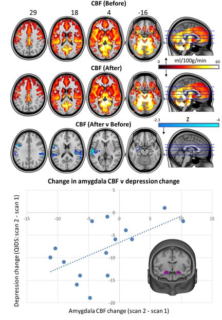 Carhart Harris, R et al. Scientific Reports 2017