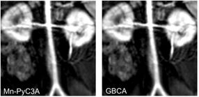Manganese-based MRI contrast agent may be safer alternative to gadolinium-based agents