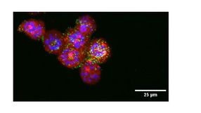 Nanoparticles to target, kill endometrial cancer