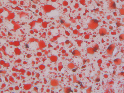 Liver Cancer: Lipid Synthesis Promotes Tumor Formation