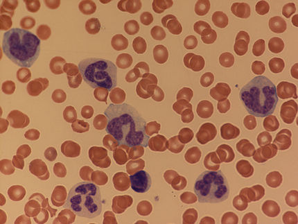 Häufigkeit von Erbgutmarkierungen charakterisiert seltenen Blutkrebs