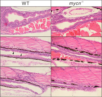 Rare human intestinal disorder is due to reduction in protein synthesis