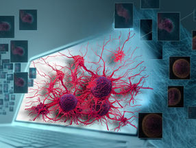 Sinonasal cancer: AI facilitates breakthrough in diagnostics