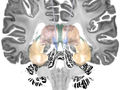 La stimulation cérébrale pourrait aider à traiter la maladie d'Alzheimer