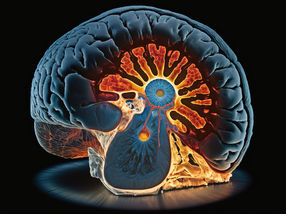 Kopfverletzungen könnten ein Risikofaktor für die Entstehung von Hirntumoren sein