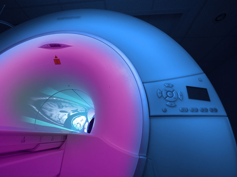 Nueva herramienta de IA para el diagnóstico de tumores cerebrales - Un algoritmo de aprendizaje profundo que puede detectar y evaluar automáticamente tumores cerebrales en PET