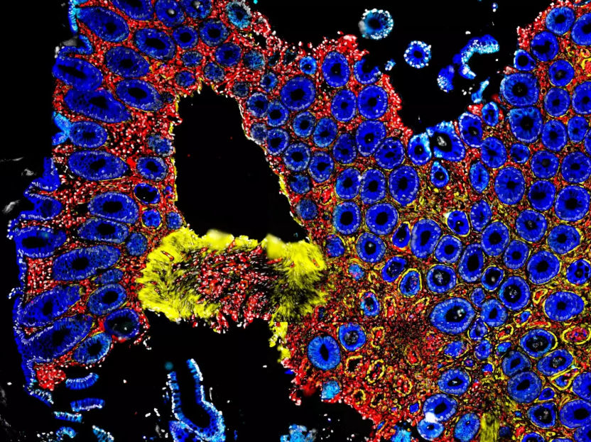 El microbioma intestinal previene reacciones inmunitarias peligrosas - Ciertas combinaciones de bacterias intestinales protegen a los pacientes de trasplante de células madre