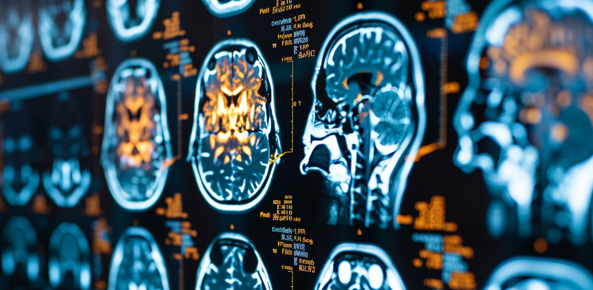 AI personalises brain tumour therapy