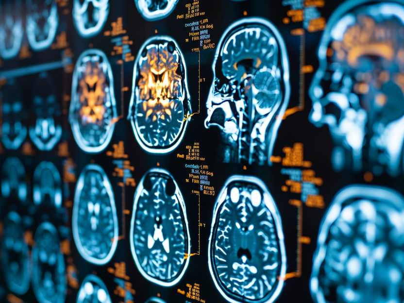 KI personalisiert Hirntumor-Therapie - Fortschritt für die personalisierte Therapie von Hirntumoren: KI identifiziert Mutationen