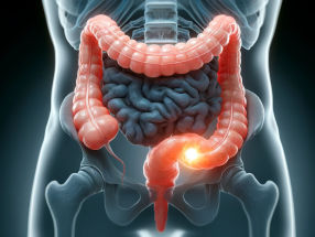 Immunotherapy significantly increases the number of patients free from bowel cancer