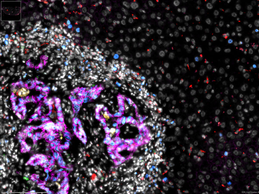 Preventing cancer cells from colonising the liver - New findings will help to develop future treatments that may hinder the formation of often fatal metastases