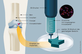 Reinforcement for the knee: 3D bioprinting with the body's own cartilage cells