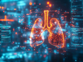 Artificial intelligence improves lung cancer diagnosis