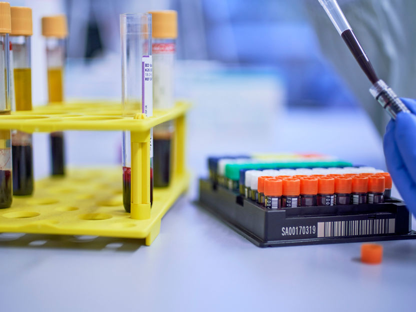 Resultados impresionantes contra las enfermedades autoinmunes - Lupus sistémico grave ya no detectable tras el tratamiento con medicamentos contra el cáncer