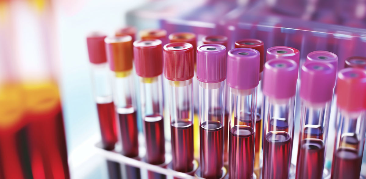 Blood Testing for so-called MicroRNAs Can Detect Dementia