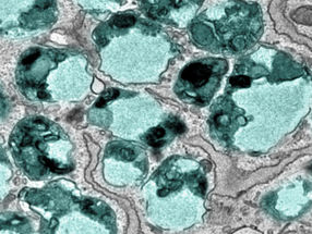 Une nouvelle cible pour traiter une maladie auto-immune grave