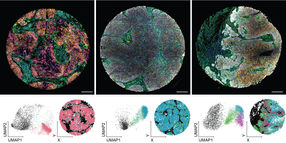 Une nouvelle méthode d'analyse de l'imagerie révolutionne le diagnostic des tumeurs de la tête et du cou