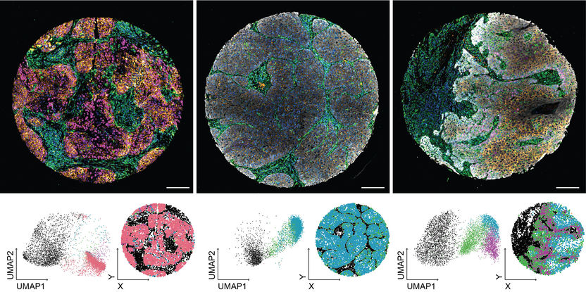 Un nuevo método de análisis de imágenes revoluciona el diagnóstico de los tumores de cabeza y cuello