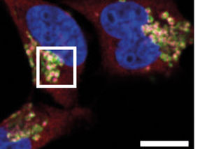 Nuevo mecanismo: cómo las células cancerosas escapan al sistema inmunitario
