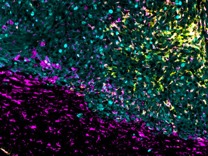 Neuer Therapieansatz greift Hirntumor mehrfach an
