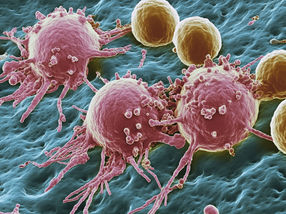 Cancer de la peau : le mode d'action de l'immunothérapie combinée décrypté