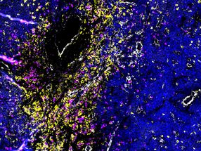 Multiples Myelom: Brechen Krebszellen aus dem Knochenmark aus, entsteht gefährliche Vielfalt