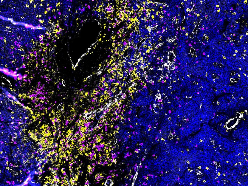 Multiple myeloma: When cancer cells break out of the bone marrow, a dangerous diversity arises - The findings could be crucial for the further development of diagnostics and therapy