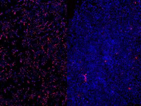 RNA anti-sentido para o tratamento da epilepsia grave em bebés prematuros