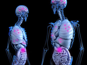 Cáncer colorrectal: los cambios genéticos controlan la formación de metástasis