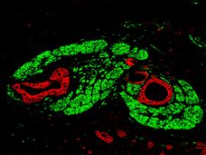 O cancro do pâncreas forma "sinapses"
