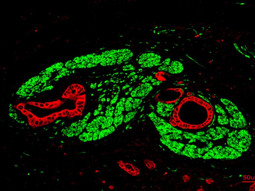 Bauchspeicheldrüsenkrebs bildet eigene „Synapsen“ - Pankreastumore nutzen Neurotransmitter für ihr Wachstum: Forschende hoffen, Medikamente zu identifizieren, mit denen sich dieser Prozess stoppen lässt
