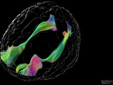 Uno studio dell'USC mappa le differenze di cablaggio cerebrale nei giovani con autismo