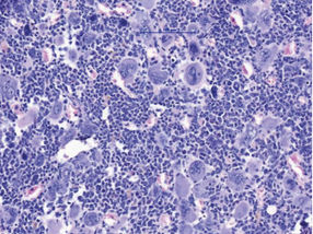 NLRP3 drives chronic blood cancer