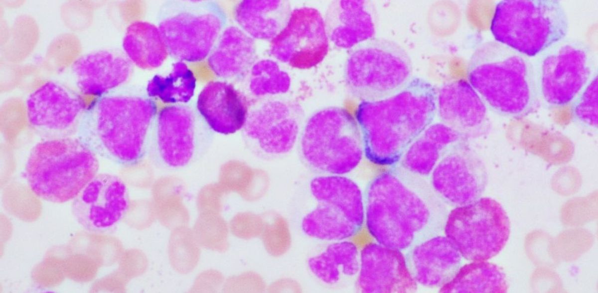 L'inhibition des protéines peut affaiblir les cellules leucémiques