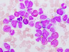 Protein inhibition can weaken leukemia cells