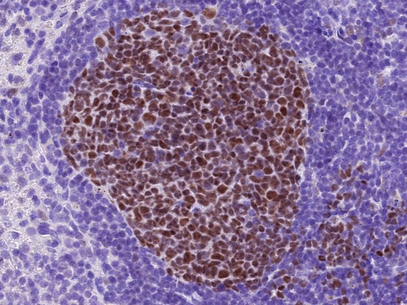 Neue Angriffsstelle zur Behandlung von Lymphomen entdeckt