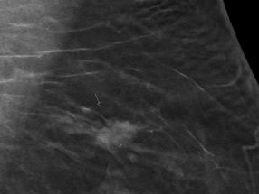 La tomosynthèse permet de détecter plus fréquemment le cancer du sein lors du dépistage