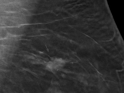 La tomosynthèse permet de détecter plus fréquemment le cancer du sein lors du dépistage