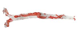 Nikotinsäure hemmt Immunzellen bei Arteriosklerose